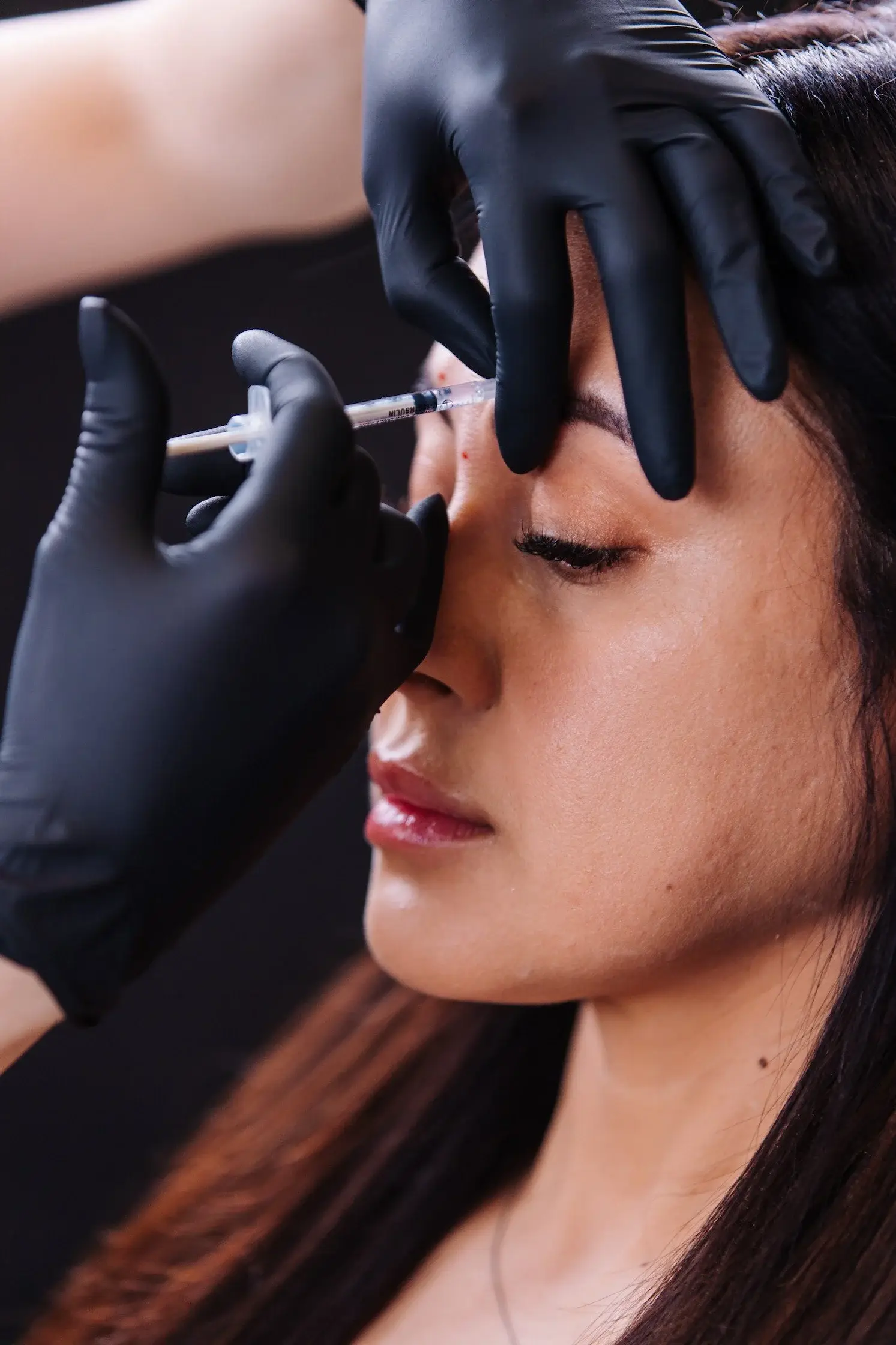 A neurotoxin injection placed near a patient’s brow with a fine needle