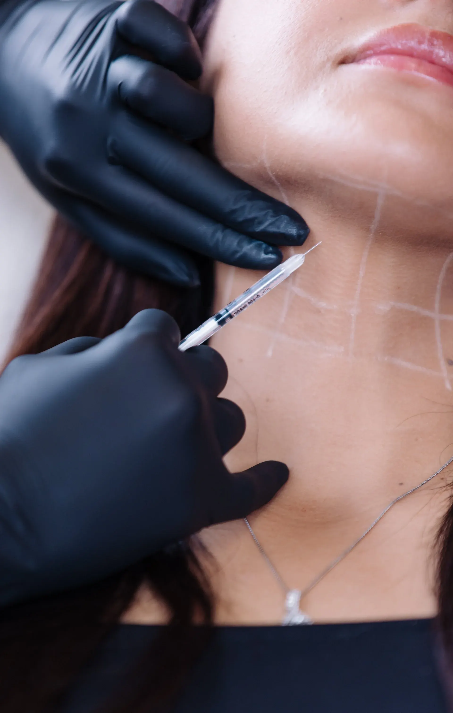 A Kybella injection beneath a patient’s chin, treatment grid marked on the skin
