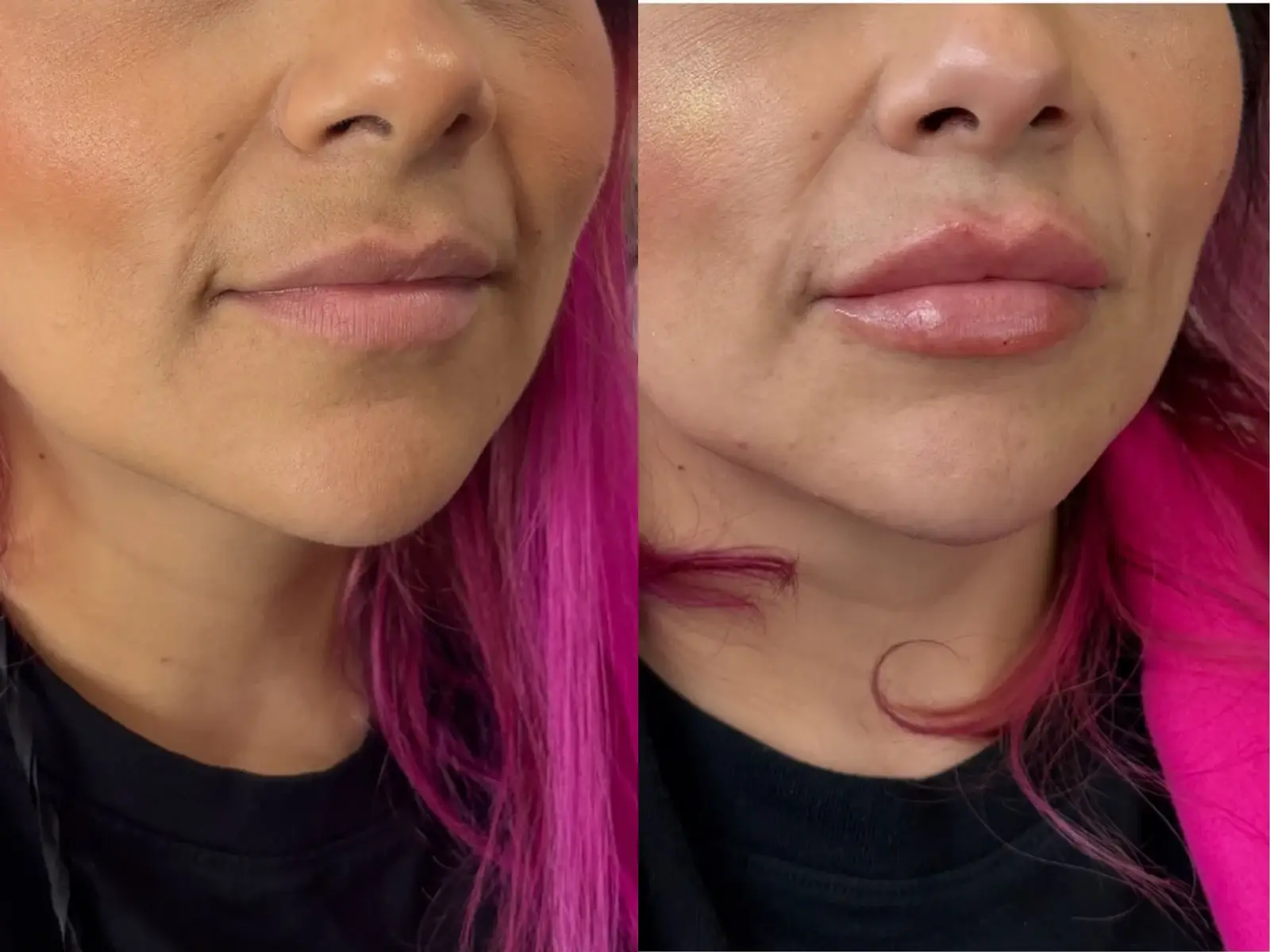 Two views of the lower face of a patient with pink streaked hair