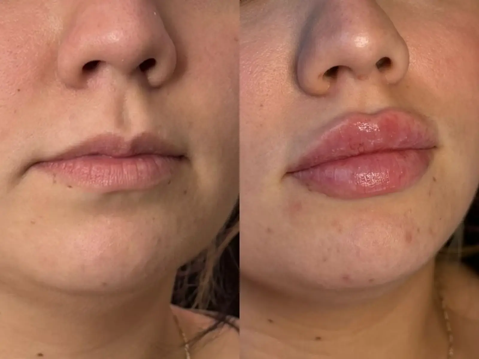 Two close views of the mouth, chin, jawline of one patient