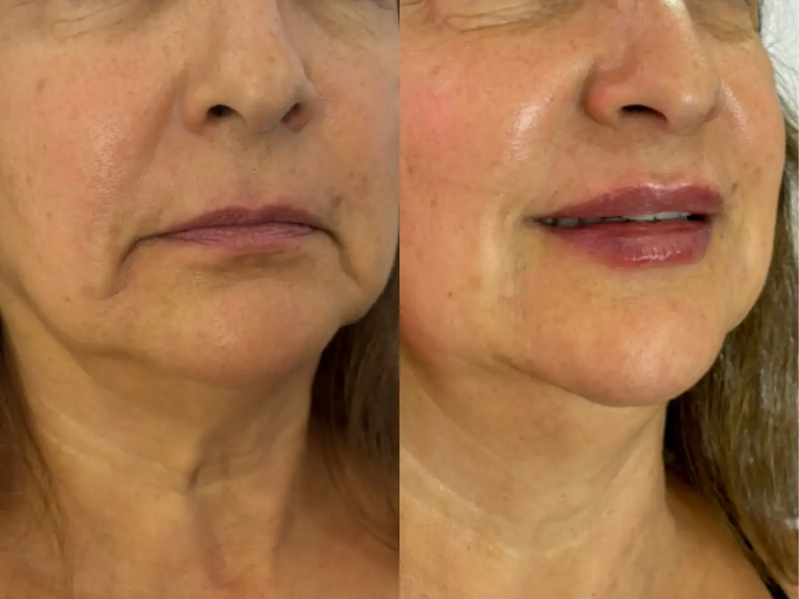 Two three-quarter views of the lower face, neck of an older patient
