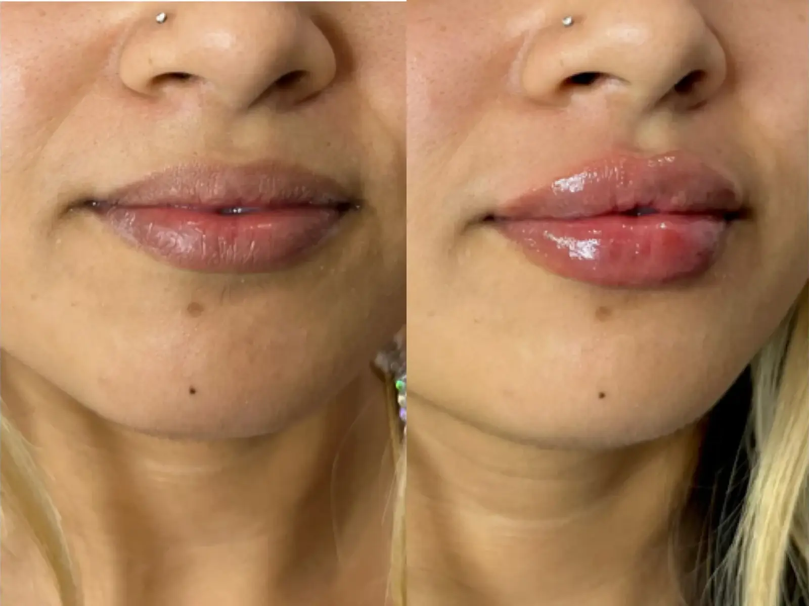 Two close views of the mouth, chin of one patient