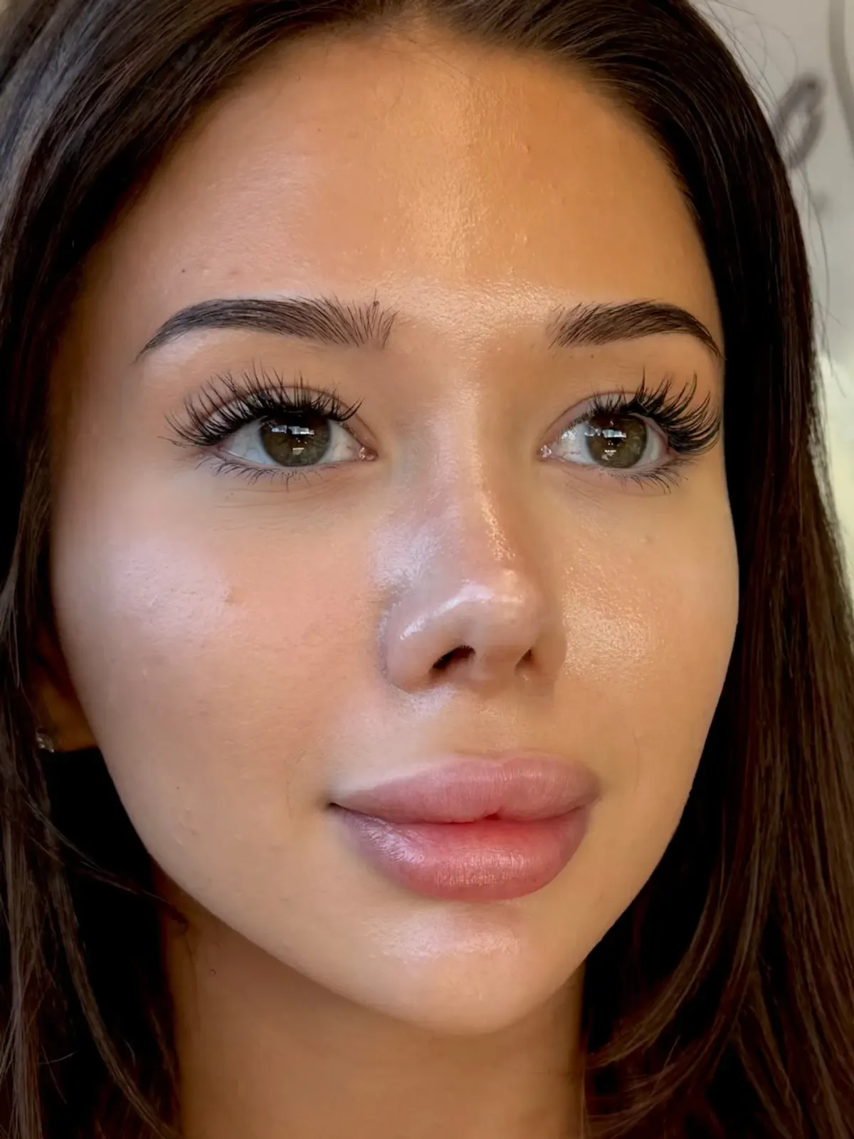 Patient in her twenties facing the camera, brows, cheeks, mouth filling the frame, after treatment