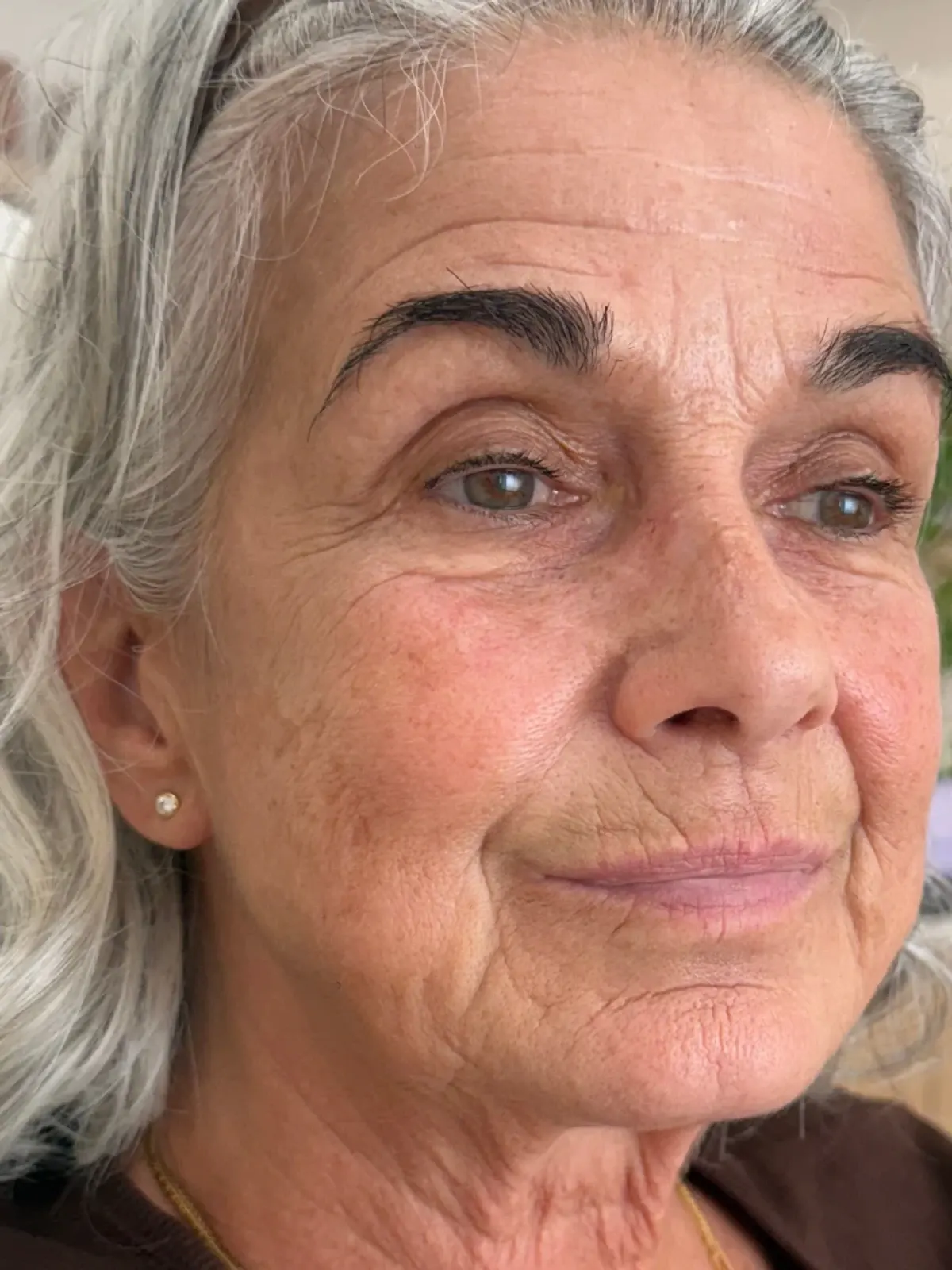 Patient with grey hair at a three-quarter angle, brow, cheek, mouth in frame, before treatment