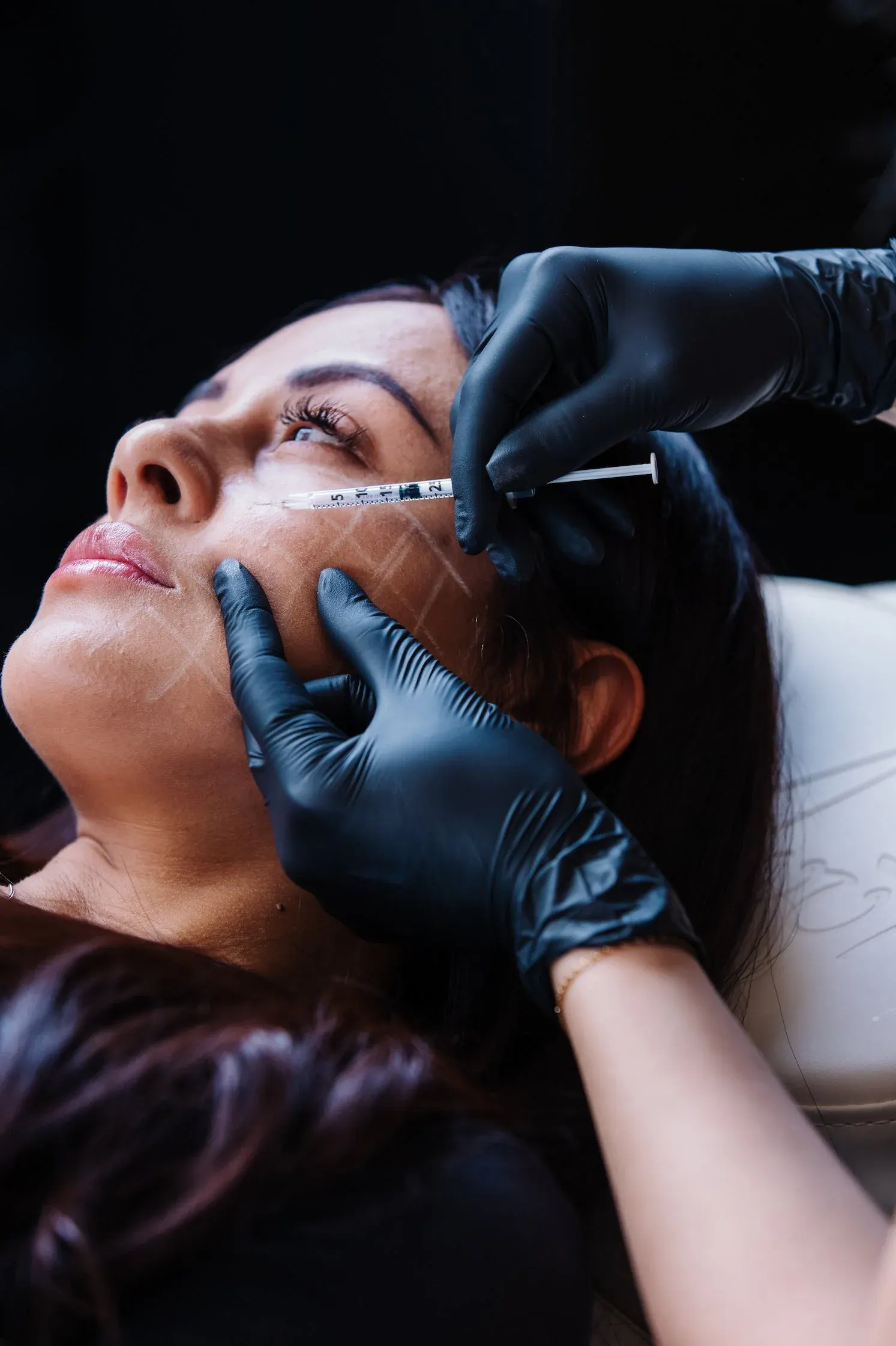 Guide lines drawn across a patient’s cheek as an injection is placed